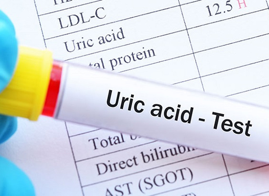 Sửa chữa thiết bị y tế, chi-so-acid-uric-bao-nhieu-thi-bi-gout-khac-phuc-bang-cach-nao